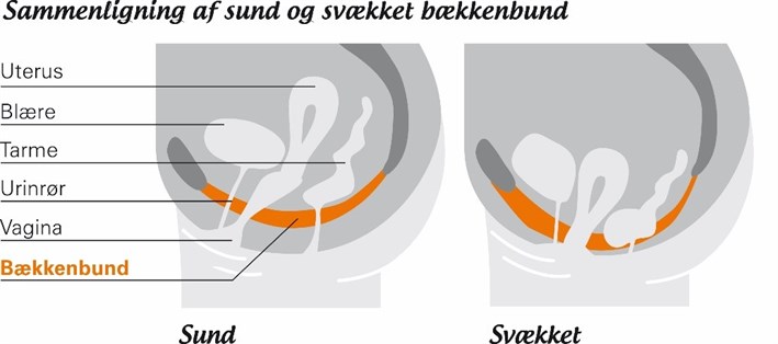 Baekkenbund Sammenligning