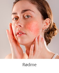 Rødme
